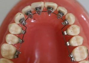 lingual-braces