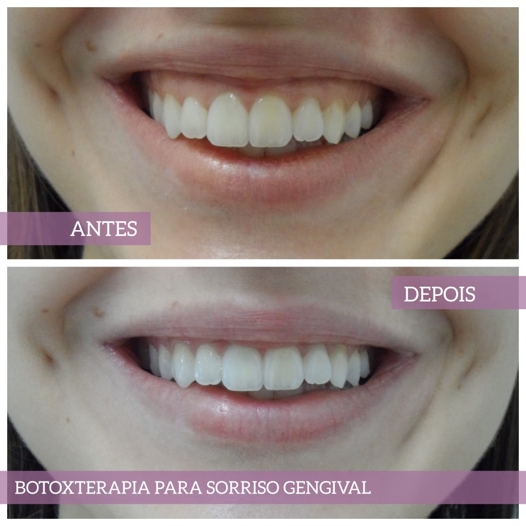 Botoxterapia para sorriso gengival.