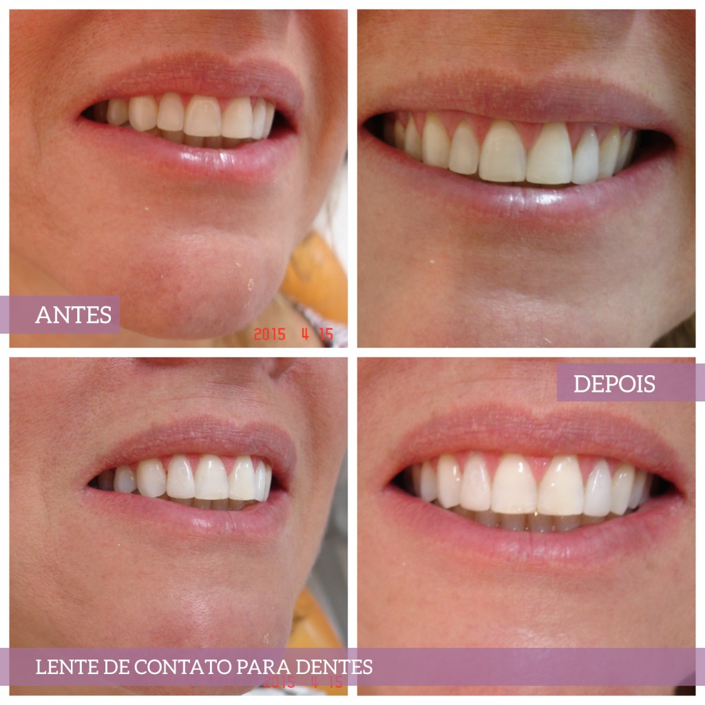 Lente de contato para dentes.